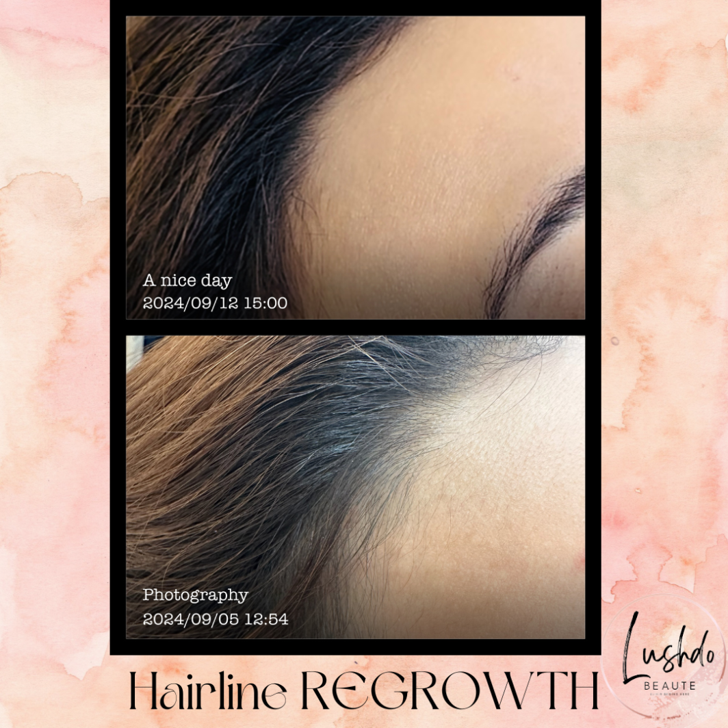 Hairline Regrowth Product Page