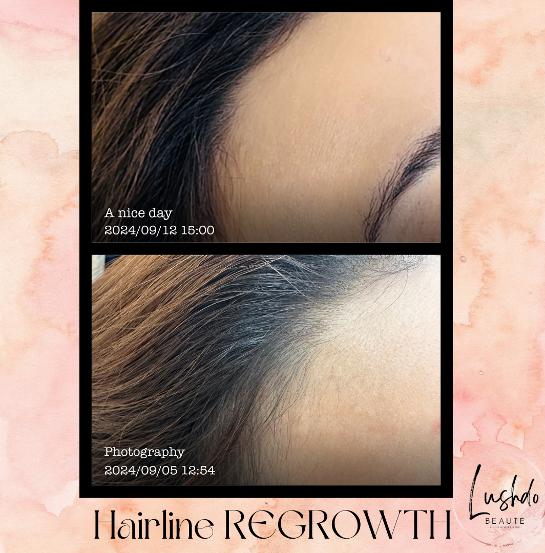 Hairline Regrowth Product Page