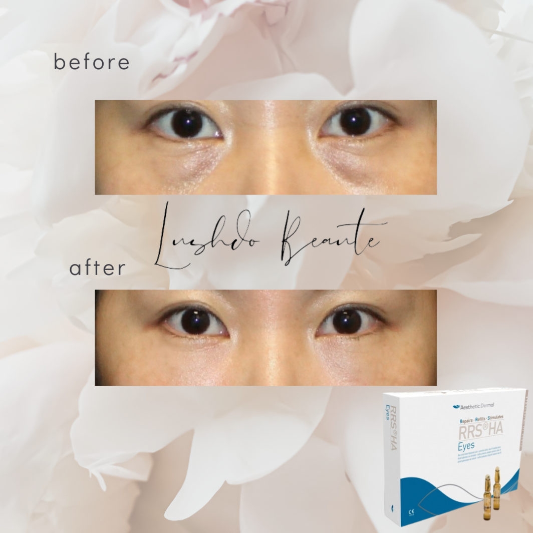 Eye Collagen Treatment Product Page / Medical Spa