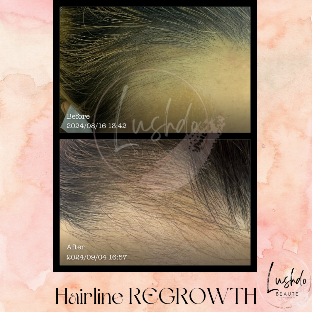 Hairline Regrowth Product Page