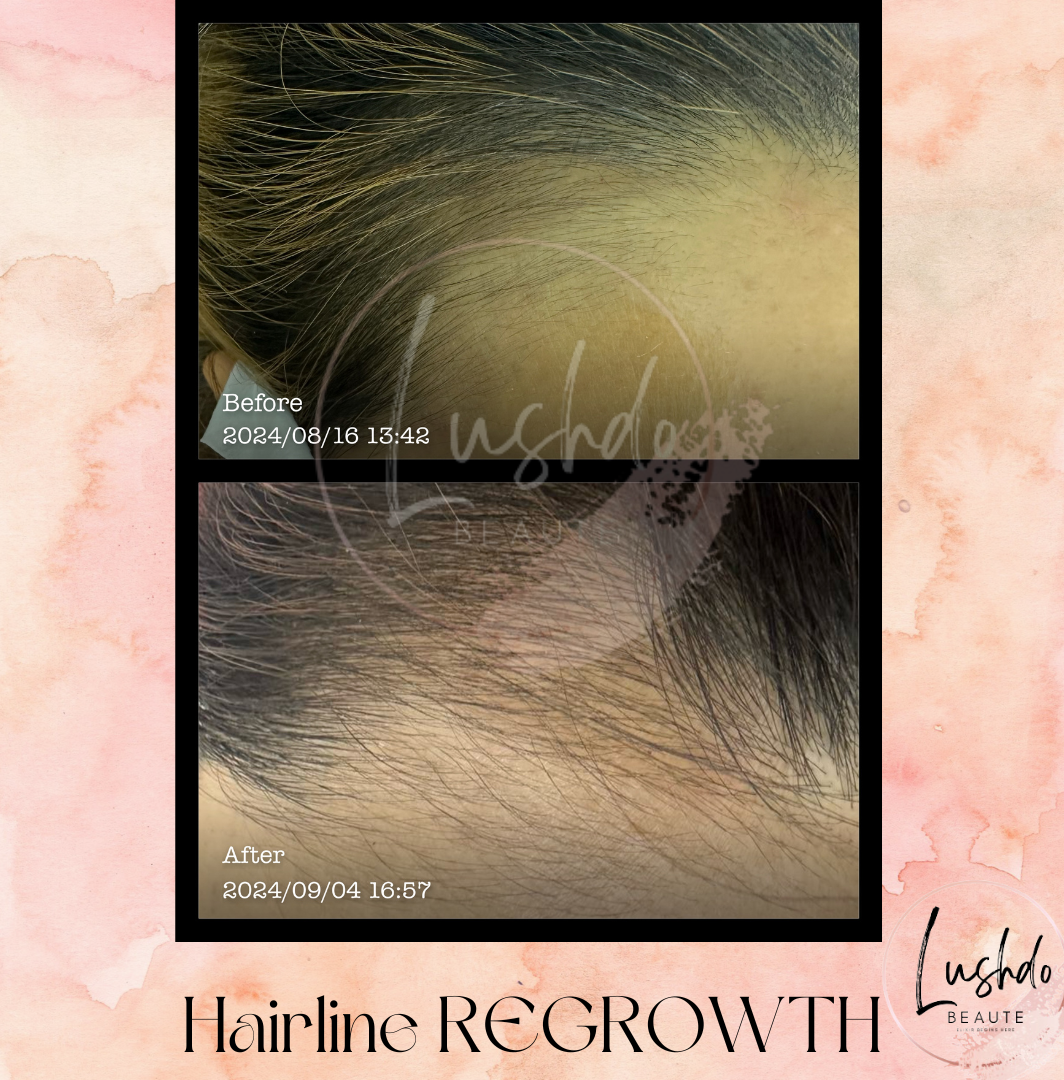 Hairline Regrowth Product Page